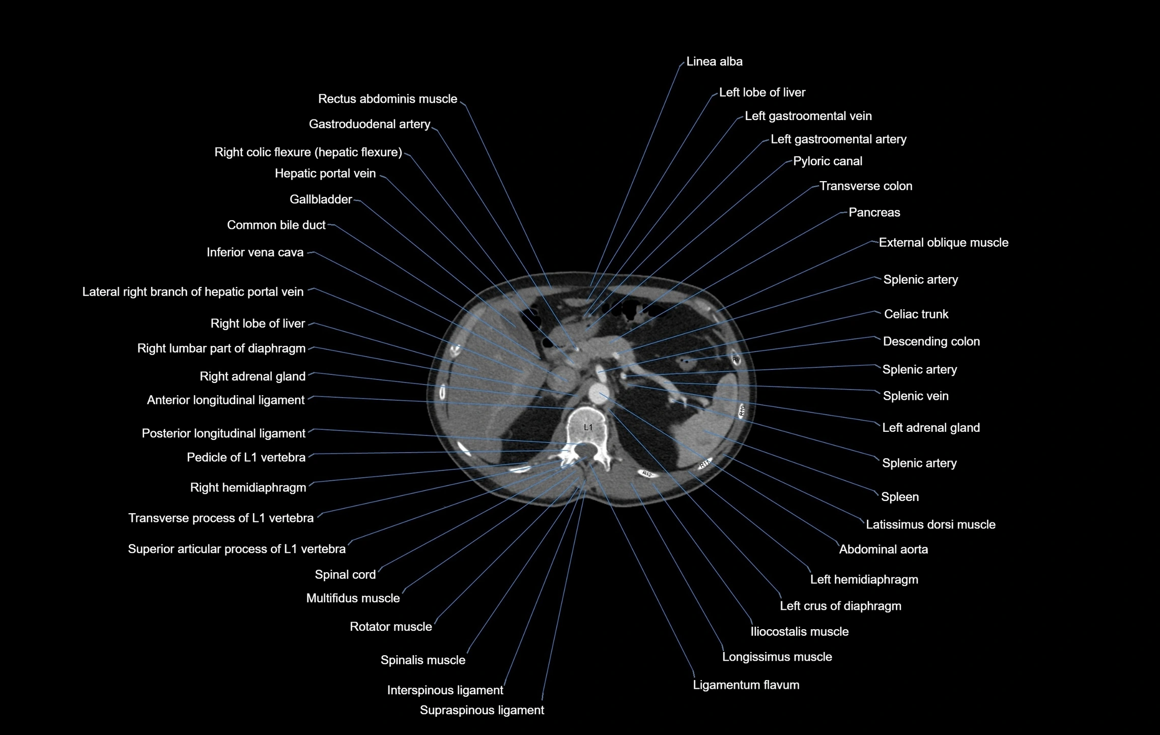 CT chest (thorax) soft tissue window labelled axial cross sectional anatomy radiology image-00124.webp